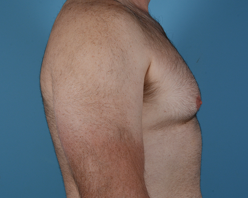 Gynecomastia Before and After | Dr. Thomas Hubbard