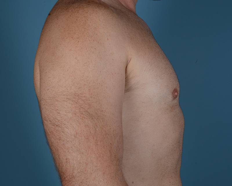 Gynecomastia Before and After | Dr. Thomas Hubbard