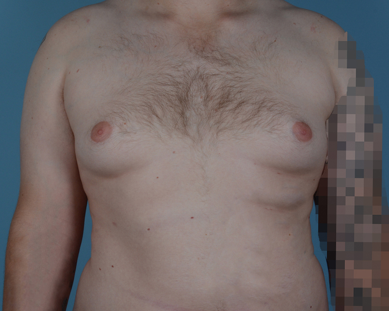 Gynecomastia Before and After | Dr. Thomas Hubbard