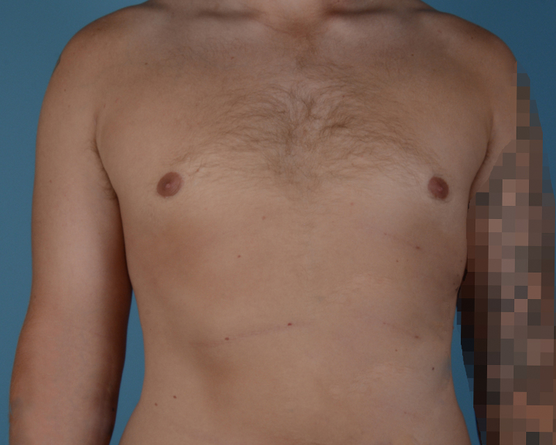 Gynecomastia Before and After | Dr. Thomas Hubbard