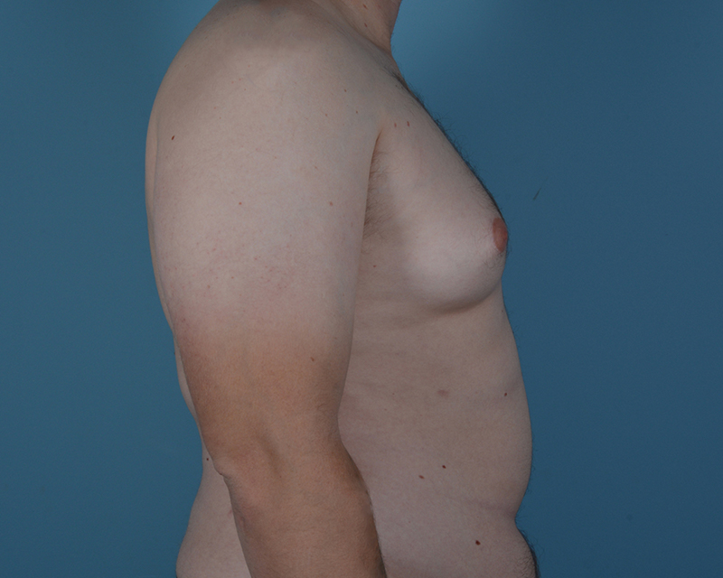 Gynecomastia Before and After | Dr. Thomas Hubbard