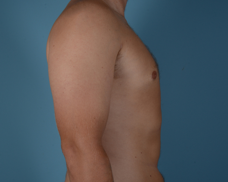 Gynecomastia Before and After | Dr. Thomas Hubbard