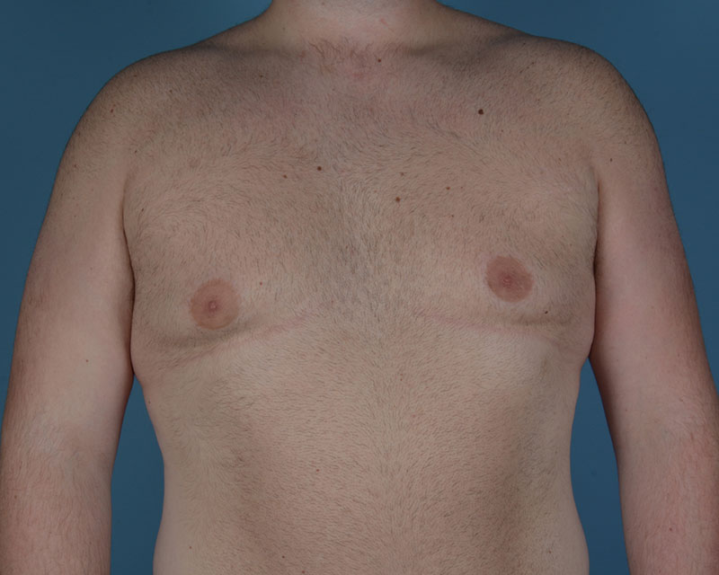 Gynecomastia Before and After | Dr. Thomas Hubbard