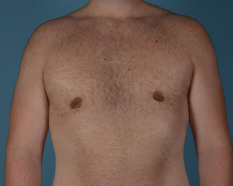 Gynecomastia Before and After | Dr. Thomas Hubbard