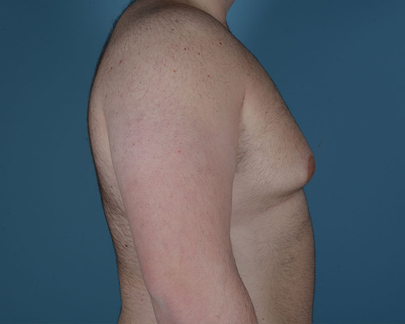 Gynecomastia Before and After | Dr. Thomas Hubbard