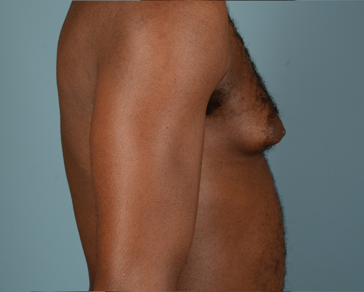 Gynecomastia Before and After | Dr. Thomas Hubbard