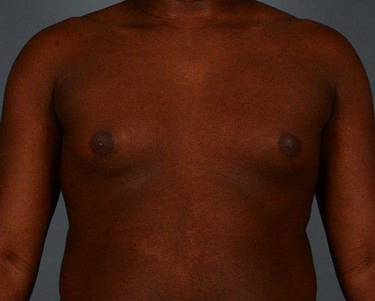 Gynecomastia Before and After | Dr. Thomas Hubbard