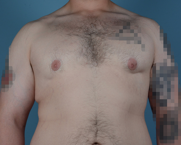 Gynecomastia Before and After | Dr. Thomas Hubbard