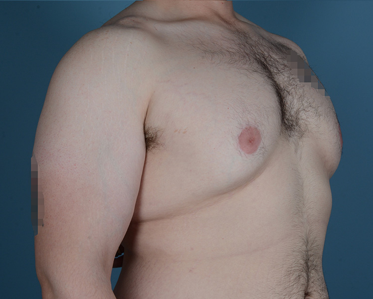 Gynecomastia Before and After | Dr. Thomas Hubbard