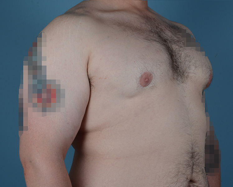 Gynecomastia Before and After | Dr. Thomas Hubbard