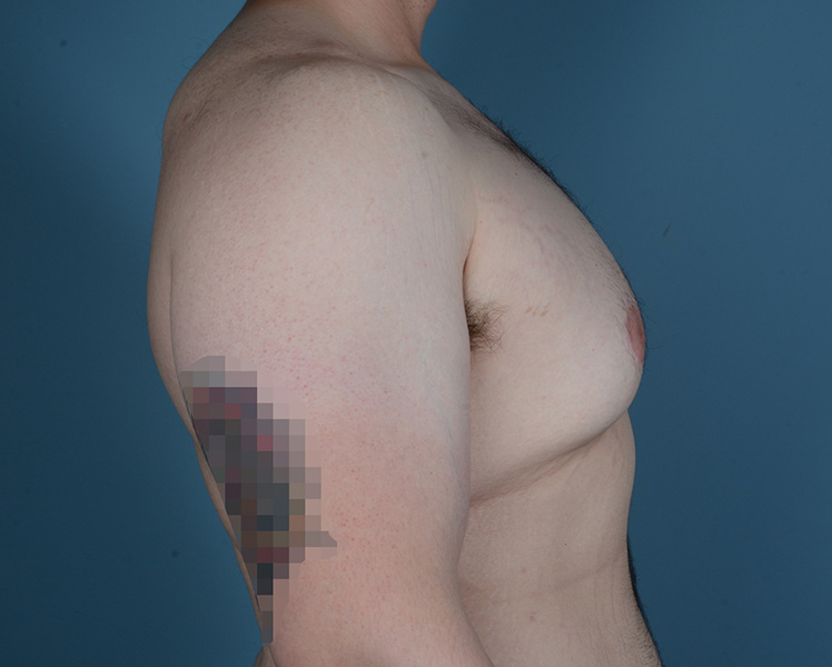 Gynecomastia Before and After | Dr. Thomas Hubbard