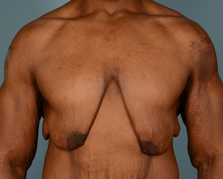 Gynecomastia Before and After | Dr. Thomas Hubbard