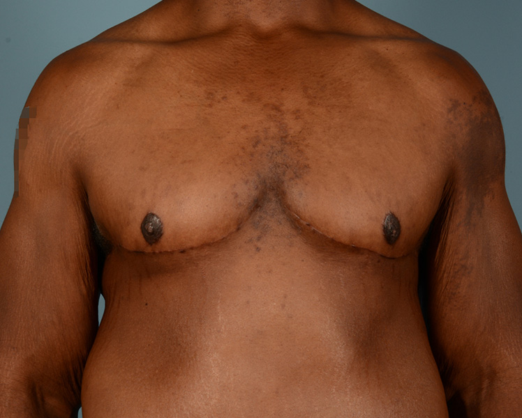 Gynecomastia Before and After | Dr. Thomas Hubbard