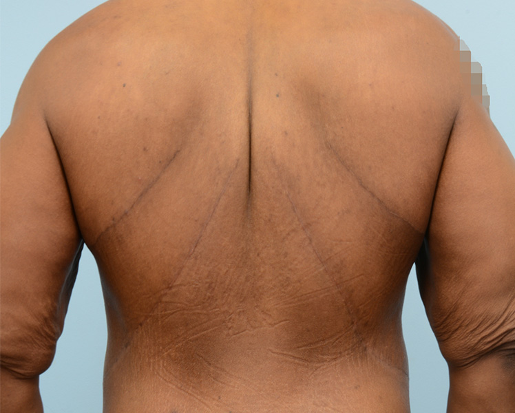 Gynecomastia Before and After | Dr. Thomas Hubbard