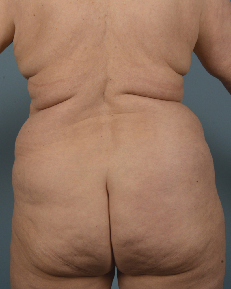 Liposuction Before and After | Dr. Thomas Hubbard