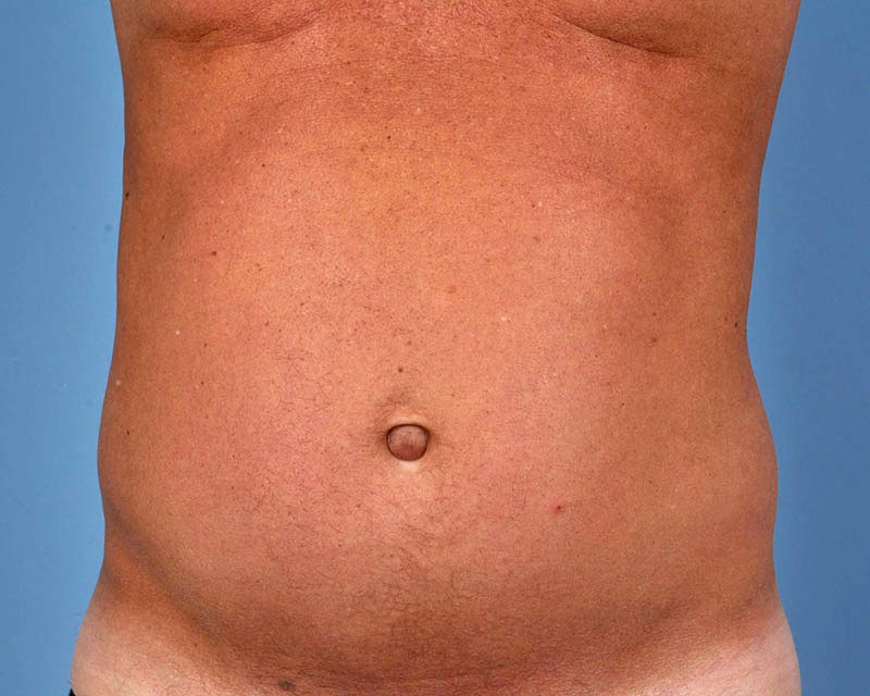 Liposuction Before and After | Dr. Thomas Hubbard