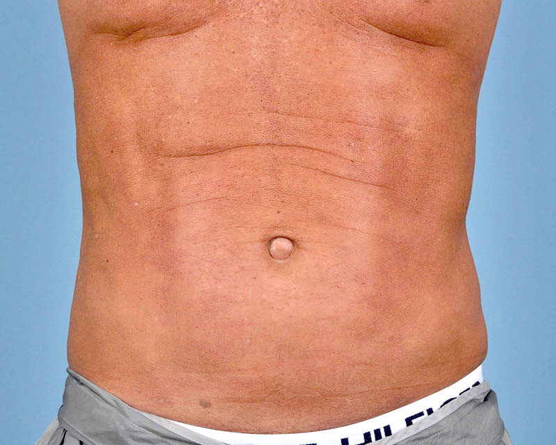 Liposuction Before and After | Dr. Thomas Hubbard