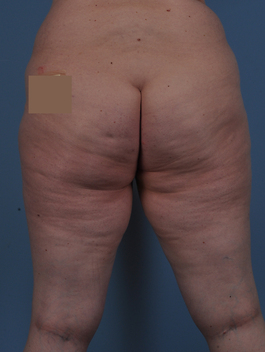 Liposuction Before and After | Dr. Thomas Hubbard