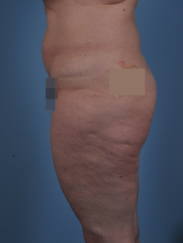 Liposuction Before and After | Dr. Thomas Hubbard