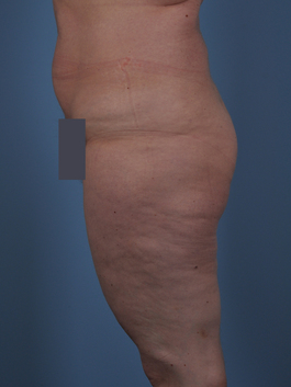 Liposuction Before and After | Dr. Thomas Hubbard