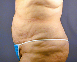 Liposuction Before and After | Dr. Thomas Hubbard