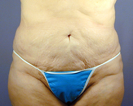 Liposuction Before and After | Dr. Thomas Hubbard