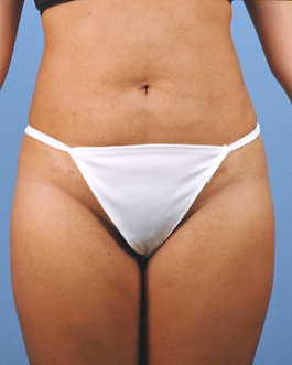 Liposuction Before and After | Dr. Thomas Hubbard