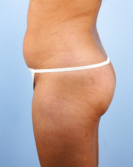 Liposuction Before and After | Dr. Thomas Hubbard