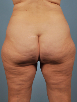 Liposuction Before and After | Dr. Thomas Hubbard