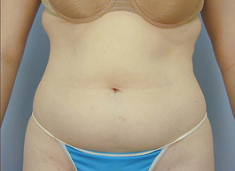 Liposuction Before and After | Dr. Thomas Hubbard