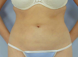 Liposuction Before and After | Dr. Thomas Hubbard