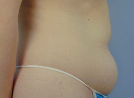 Liposuction Before and After | Dr. Thomas Hubbard
