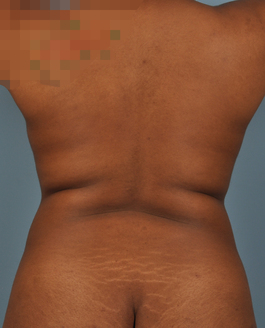 Liposuction Before and After | Dr. Thomas Hubbard