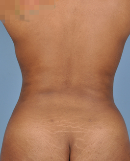 Liposuction Before and After | Dr. Thomas Hubbard