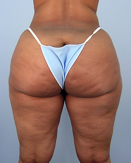 Liposuction Before and After | Dr. Thomas Hubbard