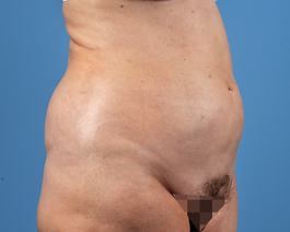 Liposuction Before and After | Dr. Thomas Hubbard