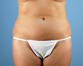 Liposuction Before and After | Dr. Thomas Hubbard