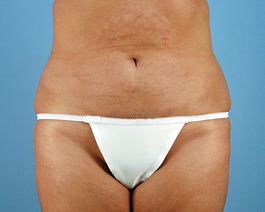 Liposuction Before and After | Dr. Thomas Hubbard