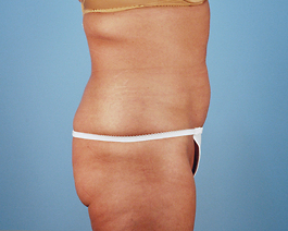 Liposuction Before and After | Dr. Thomas Hubbard