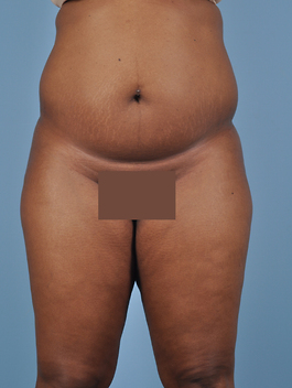 Liposuction Before and After | Dr. Thomas Hubbard