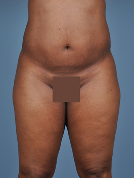 Liposuction Before and After | Dr. Thomas Hubbard