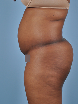 Liposuction Before and After | Dr. Thomas Hubbard