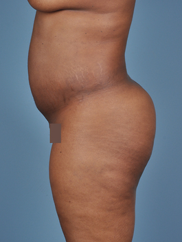 Liposuction Before and After | Dr. Thomas Hubbard