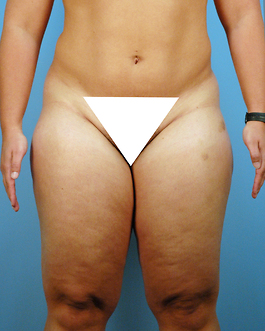 Liposuction Before and After | Dr. Thomas Hubbard