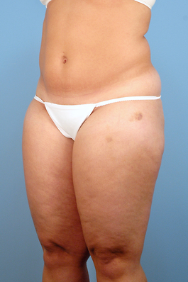 Liposuction Before and After | Dr. Thomas Hubbard