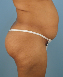 Liposuction Before and After | Dr. Thomas Hubbard