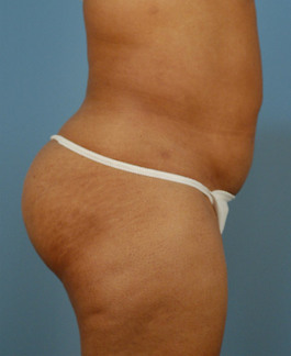 Liposuction Before and After | Dr. Thomas Hubbard