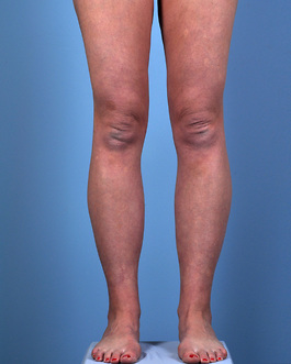 Liposuction Before and After | Dr. Thomas Hubbard
