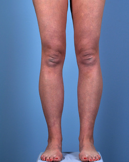 Liposuction Before and After | Dr. Thomas Hubbard