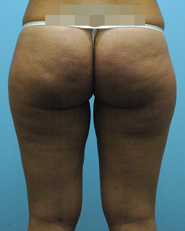 Liposuction Before and After | Dr. Thomas Hubbard